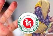 হামের উপসর্গে আরও ১৬ জনের মৃত্যু